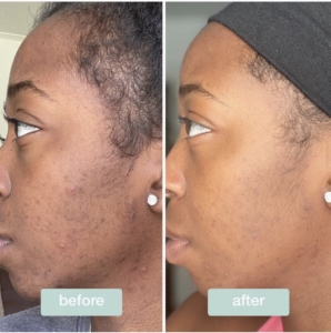 acne adulte skin studio and spa
